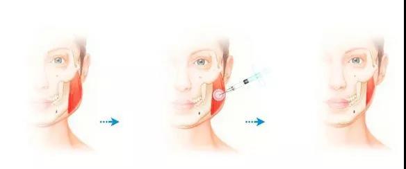 瘦脸针能维持多久的瘦脸效果,打瘦脸针的瘦脸效果可以保持多久