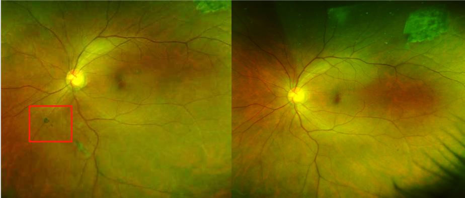 眼前有黑影是飞蚊症,眼前有小黑点飞蚊症