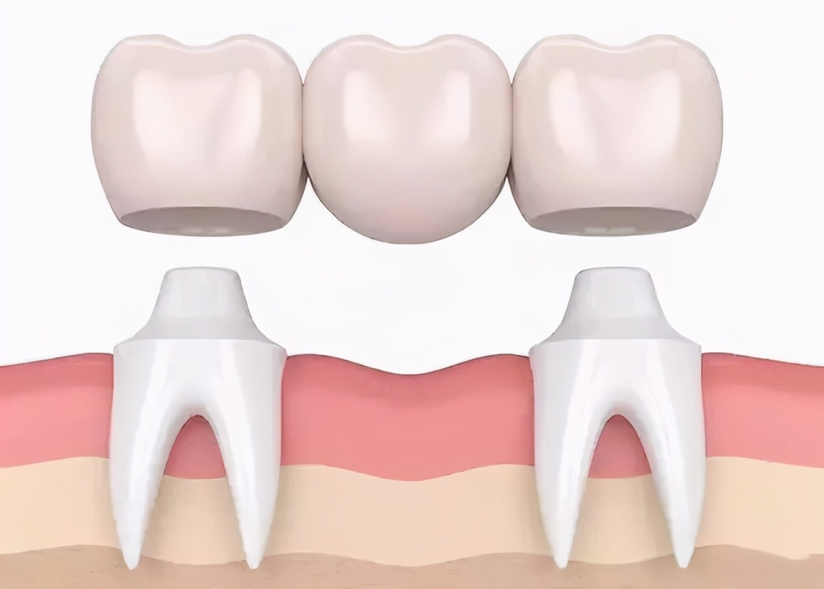 大连种植牙和种牙哪个好,大连补牙和种牙的区别