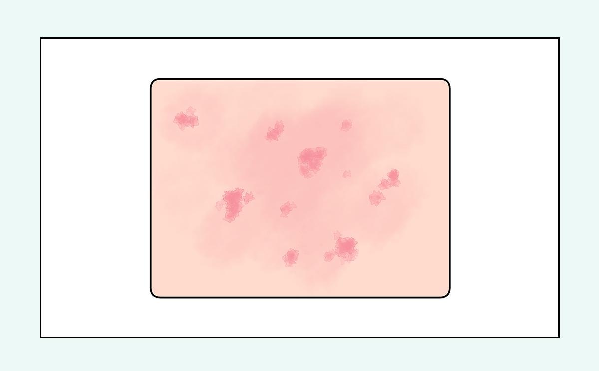 脸上的红疙瘩疼是什么原因,脸上的各种疙瘩