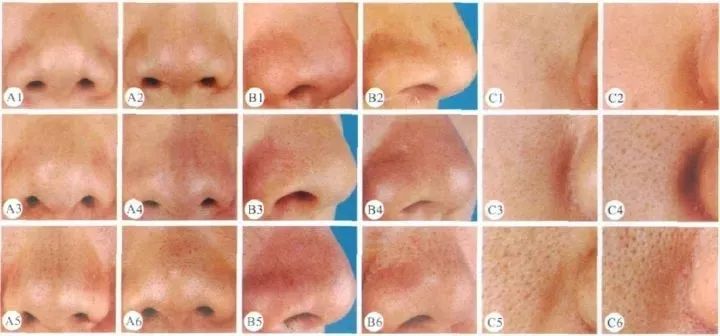 橘子皮怎么收缩毛孔,毛孔粗大橘子皮肤质还有救吗