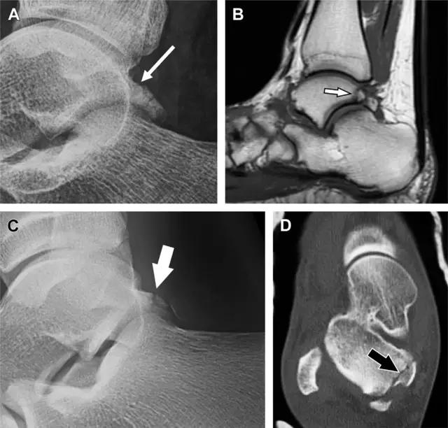 值夜班急救措施,放射科容易漏诊的骨折