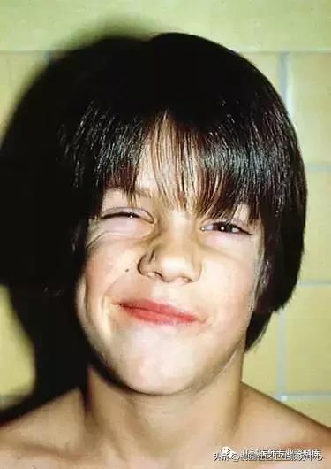 过敏性鼻炎手术的全过程,治疗过敏性鼻炎有效的药