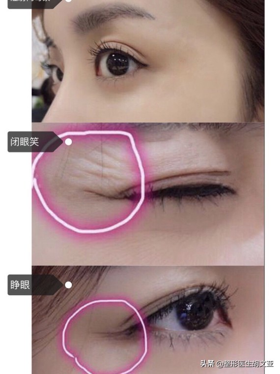 今日科普打瘦脸针前你要了解这些,打了瘦脸针前注意事项和忌口