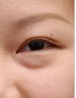 眼袋越来越严重赶紧试试这个方法,大家是否知道眼袋形成的原因呢