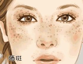 化妆品祛斑和激光祛斑哪个效果好,祛斑可以去医院但不要激光祛斑