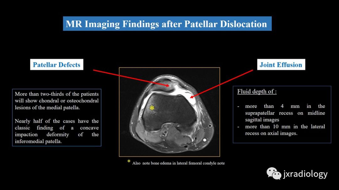髌股关节失常磁共振看什么,髌股关节混乱的影像评估