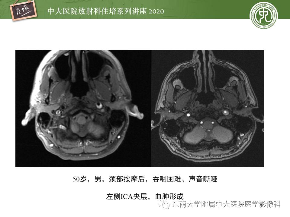 颈动脉夹层的超声表现及漏诊分析,动脉夹层与夹层动脉瘤是一样的吗