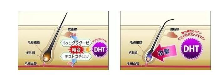 脂溢性脱发跟脂溢性皮炎区别,脂溢性皮炎和脂溢性脱发是一回事