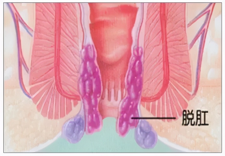脱肛不严重怎么调理,脱肛不去医院能自愈吗