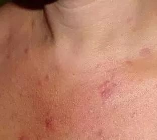 闭合性粉刺的正确消除方法,阿司匹林祛除闭合性粉刺