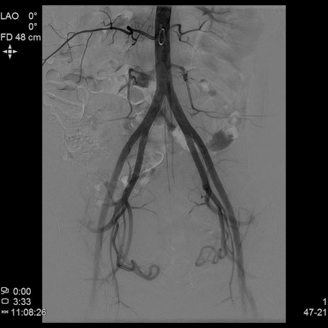 从手上扎针插管就能治子宫腺肌症——经桡动脉入路子宫动脉栓塞术
