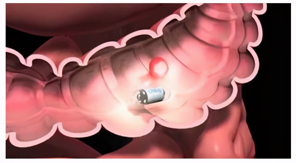黑斑息肉综合征有什么症状,黑斑息肉综合征临床表现