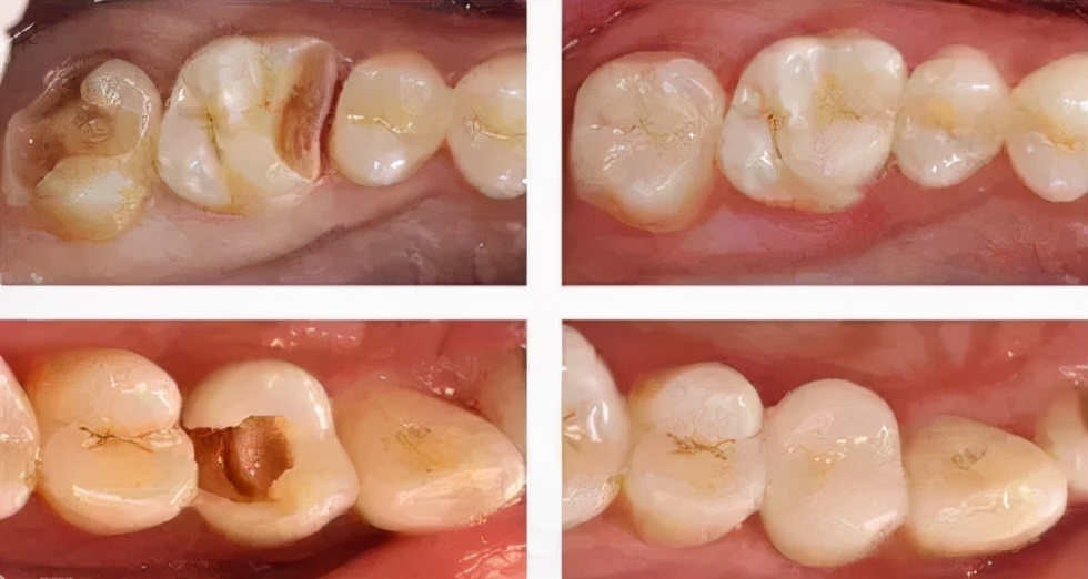 牙疼补牙的流程及步骤,补牙牙痛最好在哪里治疗