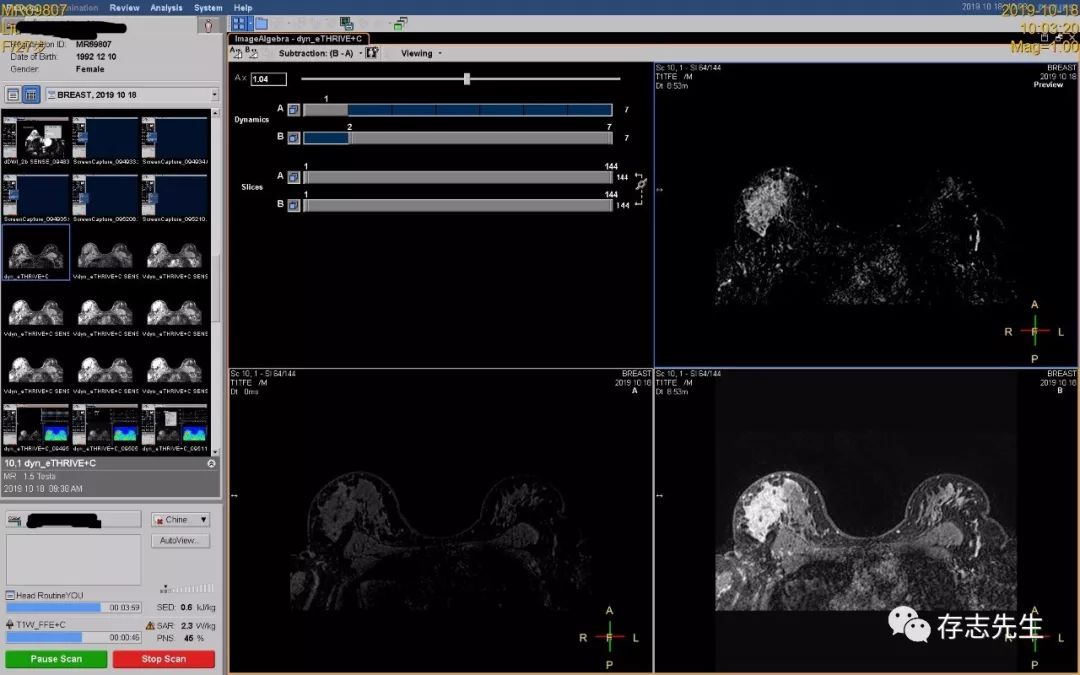 乳腺磁共振亲身经历,磁共振乳腺动态增强扫描全过程
