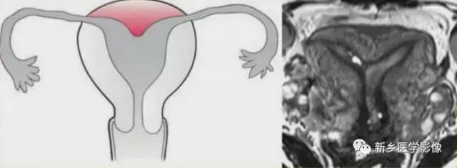 子宫发育异常，应想到的6大类常见畸形