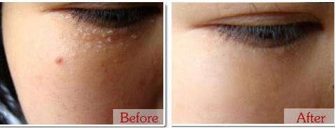 手动去脂肪粒工具,去脂肪粒神器排行榜