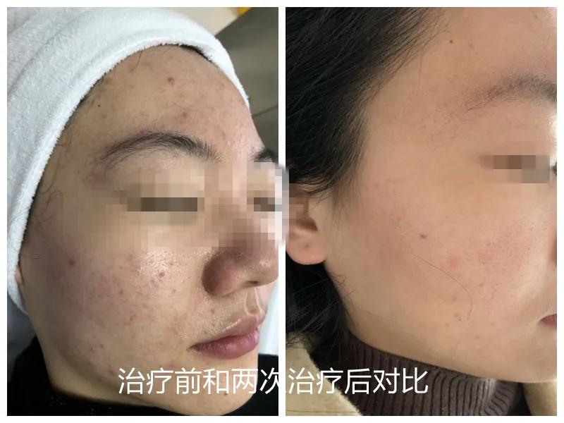 南通冰点脱毛哪家医院好,南通美容医院脱毛