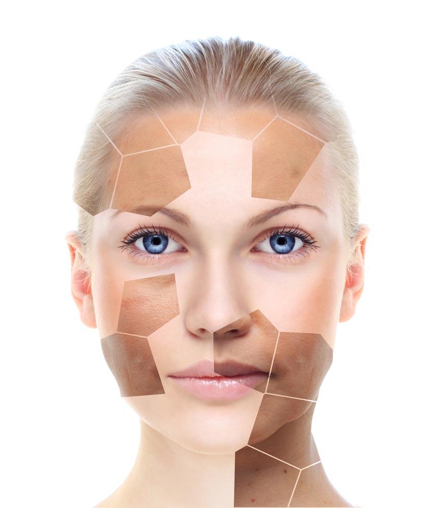 褐青斑是什么原因形成的,褐青色斑产生的原因