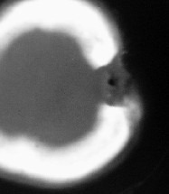 不典型的骨髓炎能根治吗,彻底治疗骨髓炎