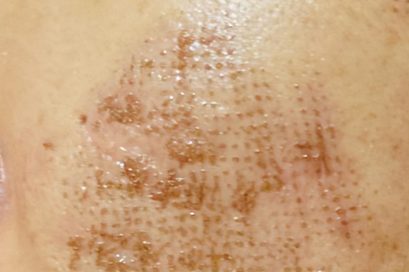 激光微创治疗后注意事项,做完有创激光怎么保湿