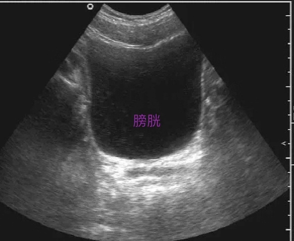 超声检查膀胱壁毛糙可以吃什么药,做膀胱彩超检查用憋尿吗