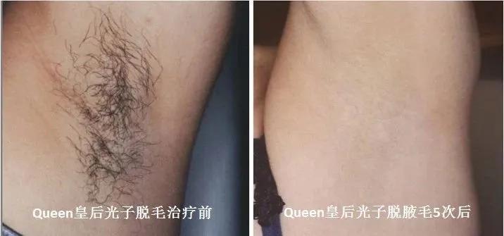 脸部脱毛和光子嫩肤可以一起做吗,油皮光子嫩肤护肤方法