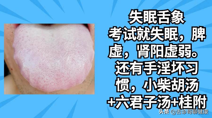 舌诊哥：遗精滑精、气短、虚汗、紧张、焦虑等舌象分析