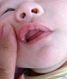 宝宝鹅口疮可以涂紫药水吗,宝宝鹅口疮长期涂制霉菌素好吗