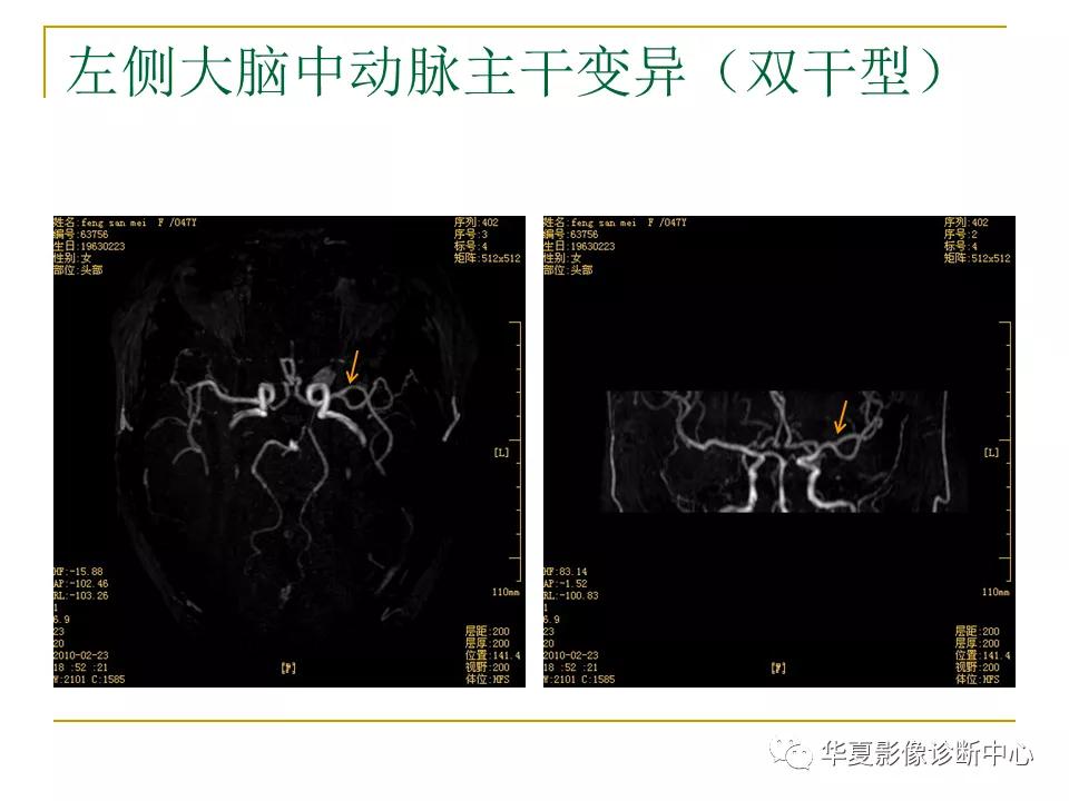 中国人脑立体定向mri应用解剖图谱,脑mri示意图