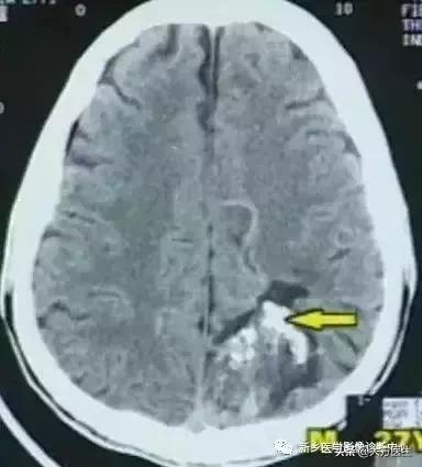 钙化灶是良性肿瘤的可能性大吗,颅内肿瘤钙化发生率最高