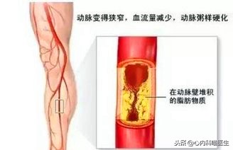 阿托伐他汀钙片降血脂降尿酸,阿托伐他汀和瑞舒伐他汀哪个升尿酸