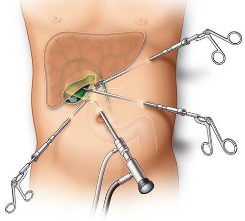 胆源性胰腺炎胆囊切除后饮食注意,胆囊切除胆总管增宽要注意饮食吗