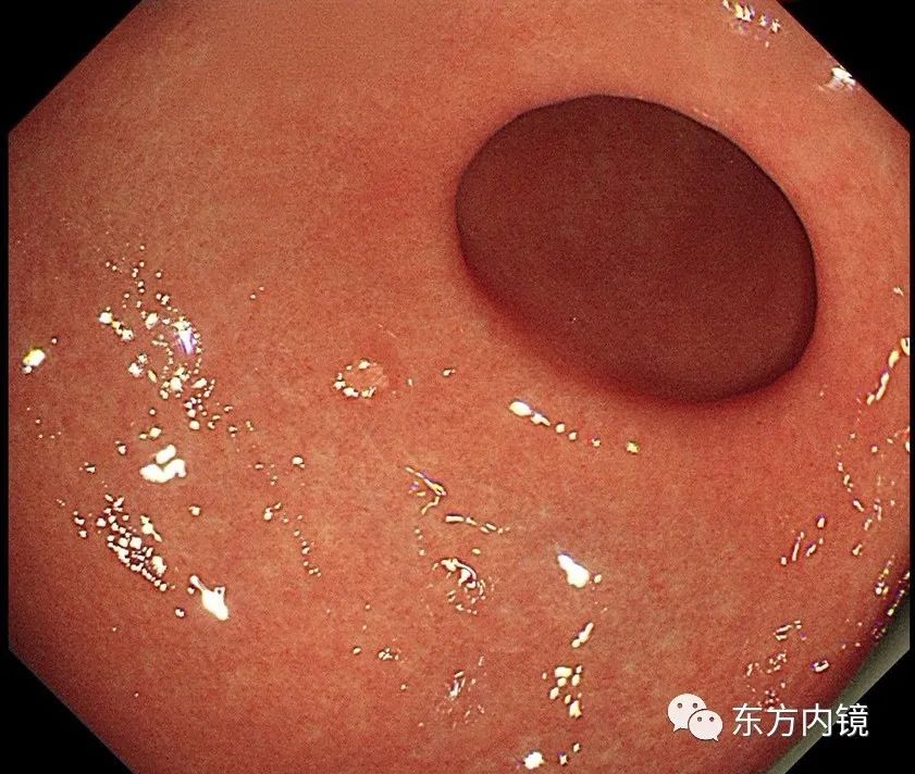 慢性浅表萎缩性胃炎怎么是轻度的,慢性浅表性胃炎中医治疗
