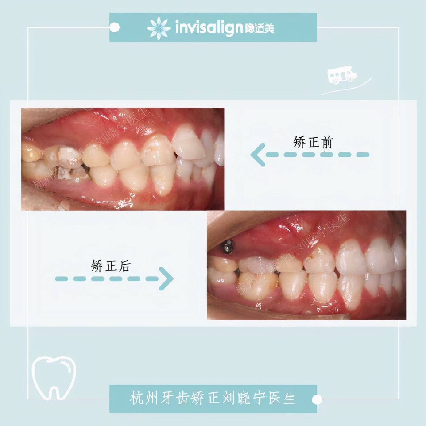 杭州牙齿矫正丨露龈笑怎么办？全面告别露龈笑的4大方法