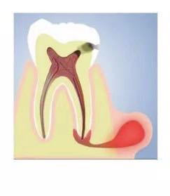 鐗欓緢鑴撳寘鎬庝箞澶勭悊,鐗欓緢鑴撳寘姘戦棿绉樻柟
