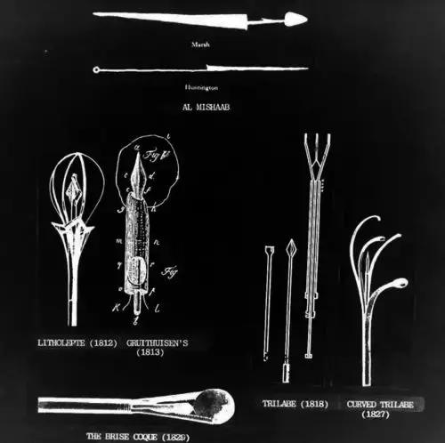 从尿道口取结石全过程,最先进的结石处理方法