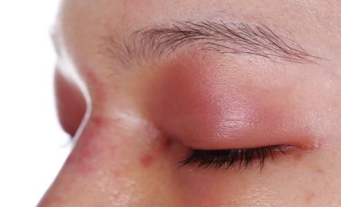 冰敷眼睛和热敷眼睛有什么好处,过敏引起的眼睛水肿冰敷还是热敷