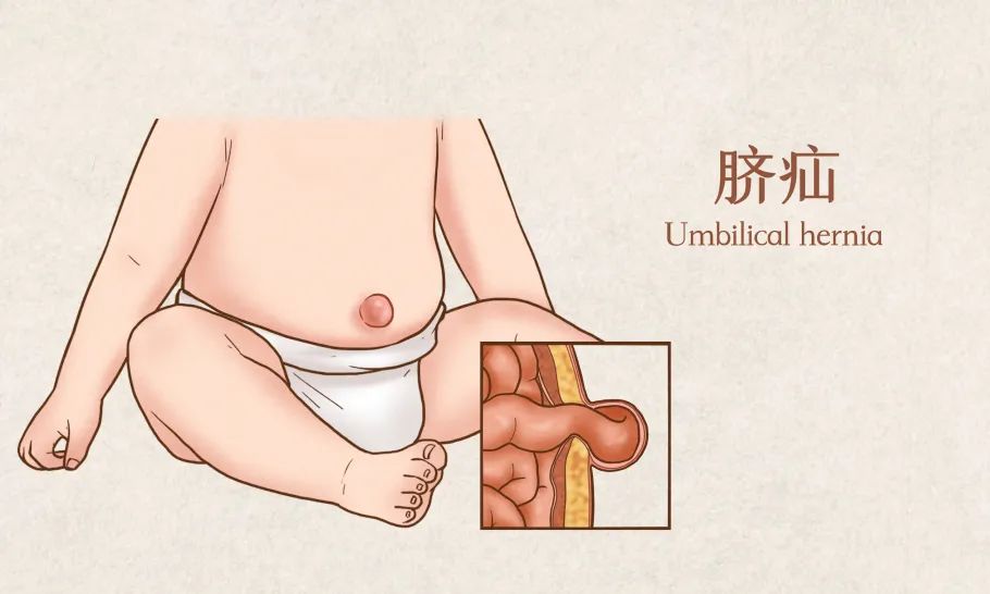 什么是脐疝带,什么是脐疝如何治疗
