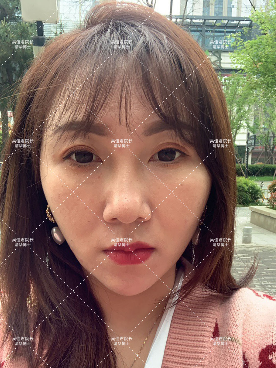 做一个拉皮手术人可以年轻多少岁,做拉皮的真实感受