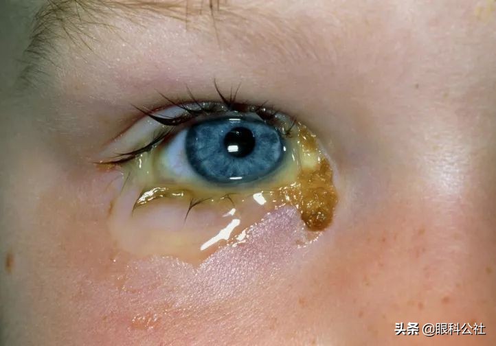 春季结膜炎的6大表现症状,疫情期间如何防结膜炎发生