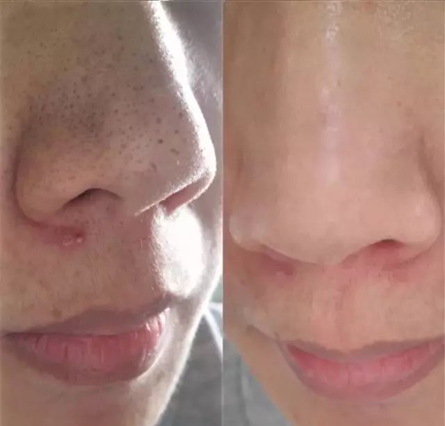 毛孔粗大皮肤暗黄该怎么改善肤质,毛孔粗大肤色暗沉应该怎么改善