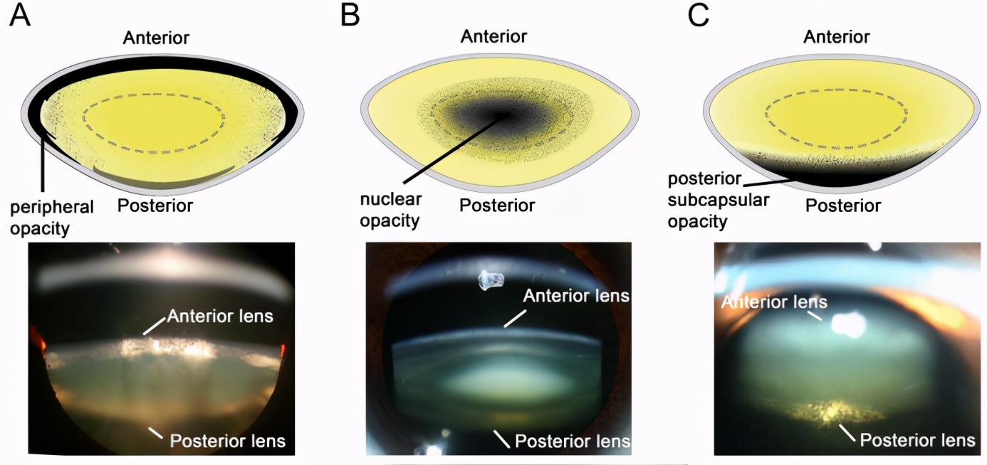 有轻微白内障吃维生素c会好吗,白内障吃维生素c药片可以吗