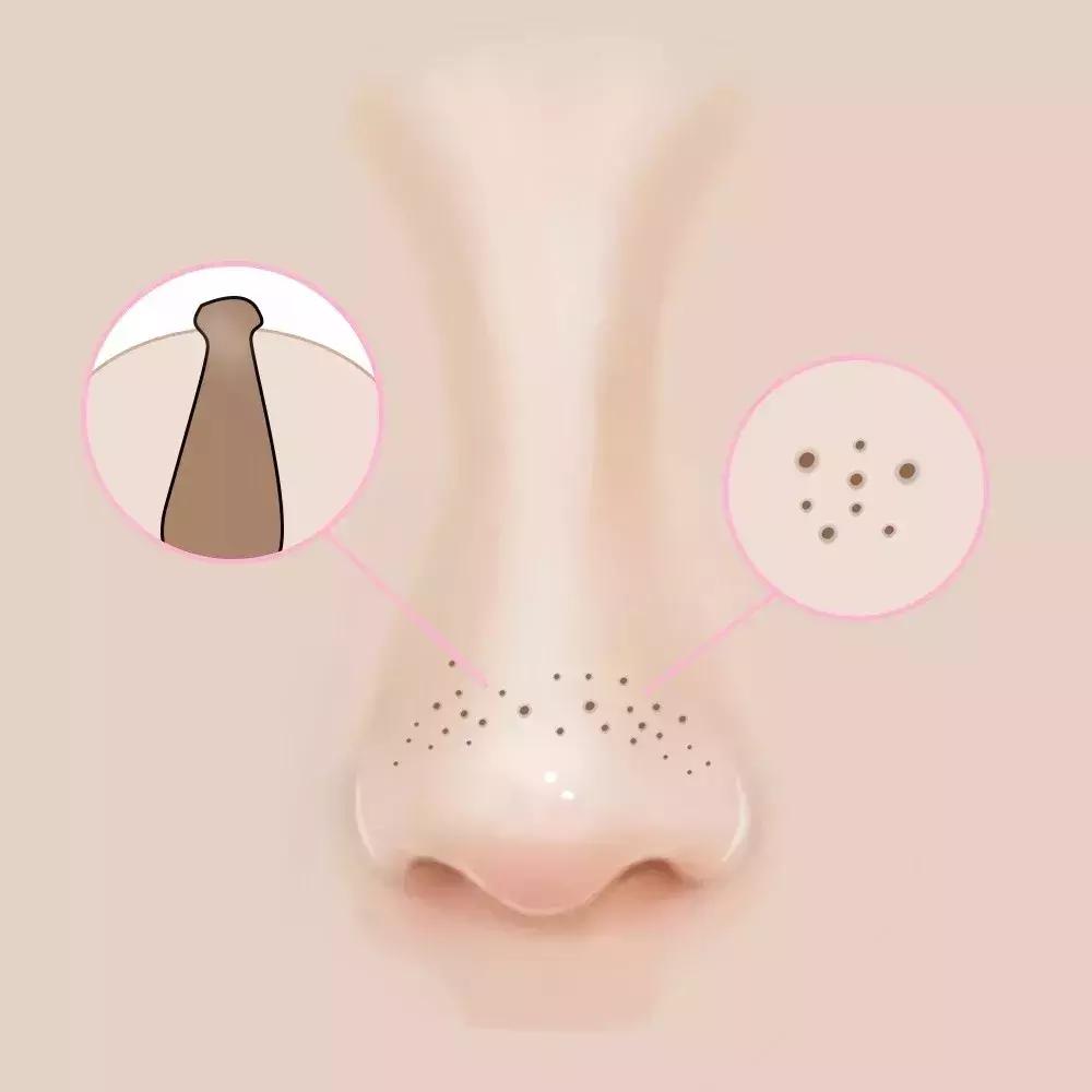 有黑头又泛红的草莓鼻怎么办,如何用医美去除草莓鼻和黑头