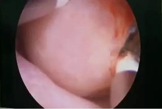 一岁小女孩轻微流血怎么回事,一周岁女宝宝外阴流血怎么办