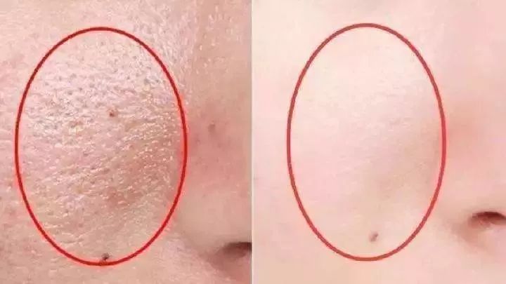 男生螨虫脸特征,螨虫脸的特征