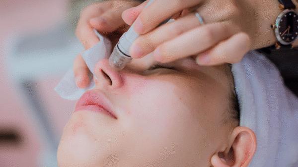 黑头多怎么办如何去除黑头,黑头贴去除顽固黑头