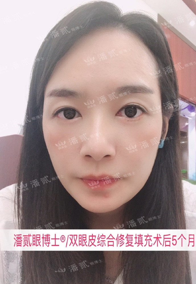 10个工作室做，9个毁，祛眼袋连卧蚕也没了，直接送我到10年后