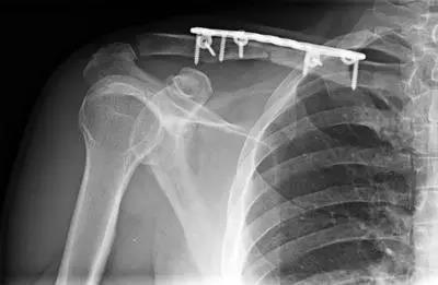 锁骨骨折打钛合金钢板容易断吗,骨折钢板内固定后钢板为什么会断
