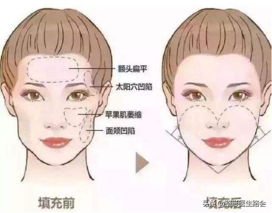 高颧骨苹果肌复位,颧骨太高苹果肌太饱满做什么手术